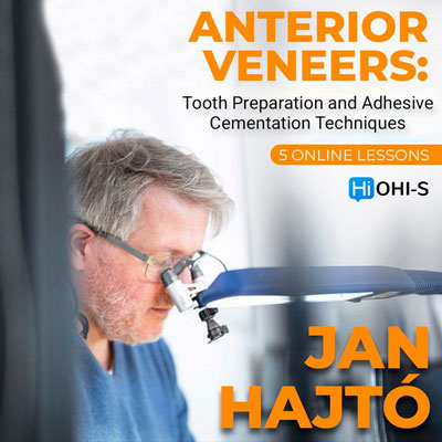 Anterior-Veneer-Tooth-Preparation-and-Adhesive-Cementation-Techniques.jpg Anterior Veneer: Tooth Preparation and Adhesive Cementation Techniques - Image 1