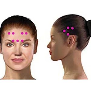 آموزش تزریق بوتاکس برای درمان میگرن مزمن طبق پروتکل Allergan | Botox Migraine Allergan Course