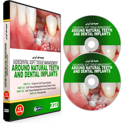 Gidedental Soft Tissue Management around Natural Teeth and Dental