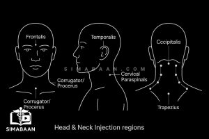 آموزش تزریق بوتاکس برای درمان میگرن مزمن طبق پروتکل Allergan | Botox Migraine Allergan Course